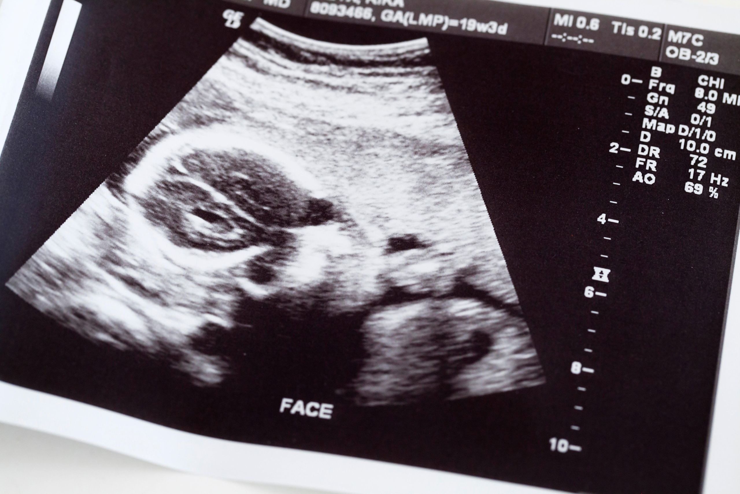 Sie dachte, ihre Schwangerschaft sei vorbei. Doch drei Wochen später entdeckten die Ärzte etwas Unfassbares